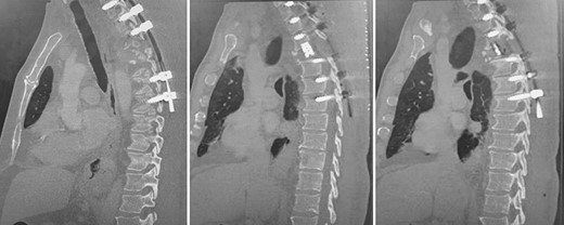 Post-operative, sagittal CT images of the T1–T7 pedicle screw fixation and expandable titanium cage in situ.
