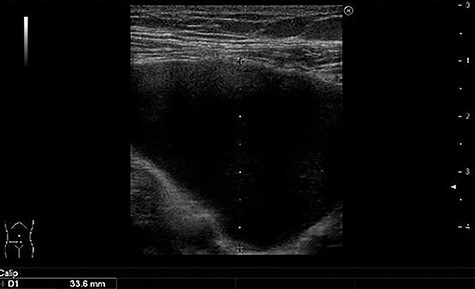 Well-defined, hypoechoic and elongated mass.
