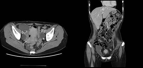 Oval fluid collection located in the right inguinal region.