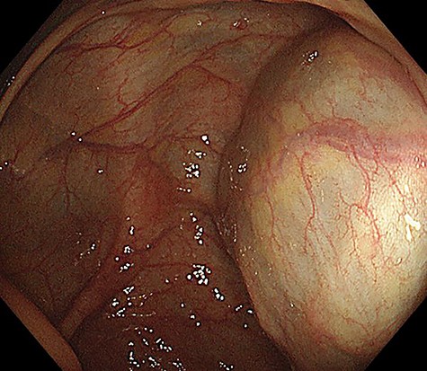 Colonoscopy image showing an unknown tissue mass that is pressed against the cecal wall from the outside.