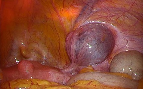 Laparoscopic finding.