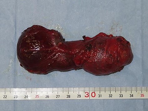 Resected hydrocele.