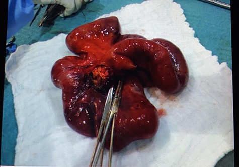 The resected segment of small bowel with part of the mesenteric tumor.