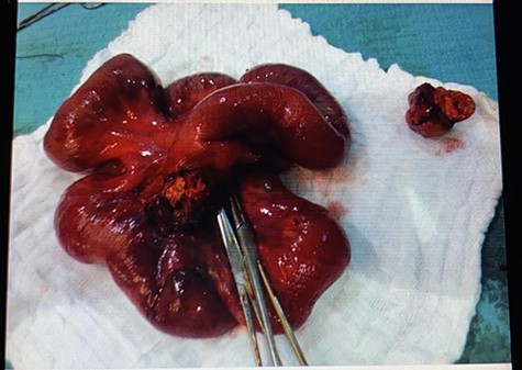 The resected segment of small bowel with part of the mesenteric tumor and a separate piece of it next to the resected segment.