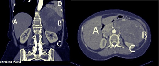 Abdominal computed tomography: A: liver, B: mass, C: left kidney.