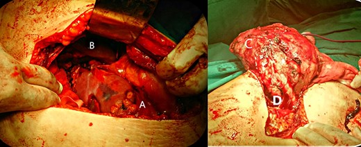Surgical operation. A: mass, B: liver, C: enucleated mass, D: vascular peduncle.