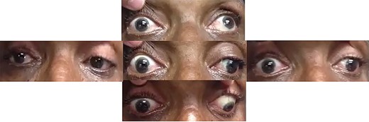 Clinical photograph of the patient’s upper face revealed a complete ptosis of right upper eyelid. Elevation of right upper eyelid and evaluation of extraocular movements revealed absence of right eye movement in dextroversion, levoversion, sursumversion and deorsumversion.
