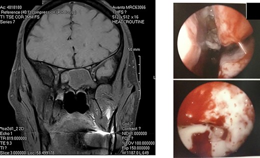 A: Magnetic resonance imaging (coronal view) reveals an expansile sphenoid sinus mass with fluid characteristics with extension into the cavernous sinus on the right. B: Intra-operative view through an endoscope reveals mucopurulent material from right sphenoid ostium. Sphenoid sinus reveals clumps of extramucosal ‘peanut buttery’ visco-elastic material (allergic mucin).