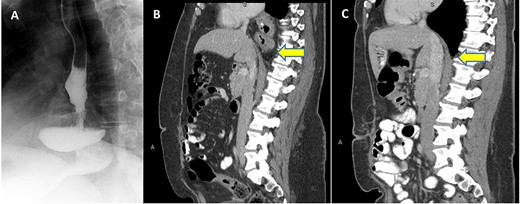 (A) UGI series with SLG in an intrathoracic position; (B) Preoperative CT scan in sagittal view with evidence thoracic migration of the stomach with partial organoaxial volvulus; (C) CT scan 1 year postoperatively confirming intact repair.