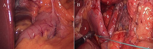 (A) Laparoscopic view of gastric sleeve herniation through esophageal hiatus (1. right crura of diaphragm covered by gastro-hepatic ligament just lateral to esophageal hiatus, 2. gastric antrum); (B) laparoscopic view of dissected esophageal hiatus (3. caudate lobe, 4. right crura of diaphragm, 5. left crura of diaphragm, 6. aorta, 7. distal esophagus).