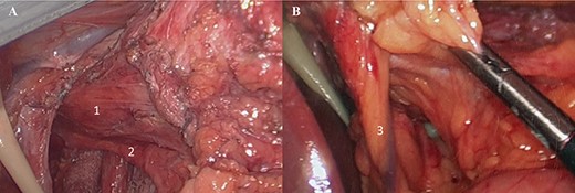 (A) Laparoscopic view (1: distal esophagus, 2. posterior vagus nerve); (B) 3. left gastric artery.