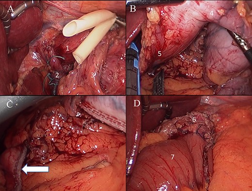 (A) Laparoscopic view posterior hiatal hernia repair (1: distal esophagus, 2: final aspect closed esophageal hiatus, 3: left gastric artery); (B) excision of gastric sleeve remnant (4. sleeve remnant, 5. fist portion of duodenum); (C) duodenal stump staple line; (D) final aspect of gastrojejunostomy (6: gastric pouch, 7: alimentary limb).