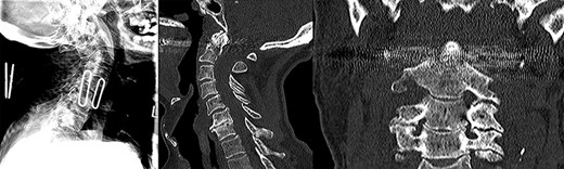 Preoperative lateral plain cervical radiograph (left), mid-sagittal (middle) and coronal (right) CT scans showing Grauer type IIB odontoid fracture without exaggeration of the atlantodental interval (ADI) suggestive of an intact transverse atantal ligament (TAL).