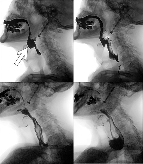 Postoperative video fluoroscopy demonstrating recurrent zenker’s diverticulum (white arrow) filling preferentially (superior left) and contrast subsequently flowing relatively easily into the esophagus following re-excision of the pouch with an incision into the cricopharyngeous muscle (inferior left and right).