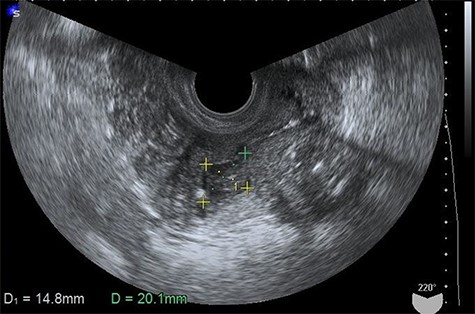 Transvaginal ultrasonogram showing the presence of hypoechoic fluid in the uterine cavity.