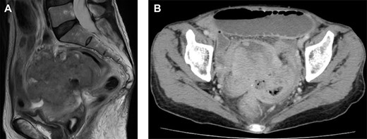 Magnetic resonance imaging and computed tomography (CT) findings preoperatively. (A) Sagittal T2-weighted MRI scan demonstrating a pelvic mass involving the uterus and rectum. (B) CT scan showing expansion of the intestines and the absence of free intraperitoneal air.