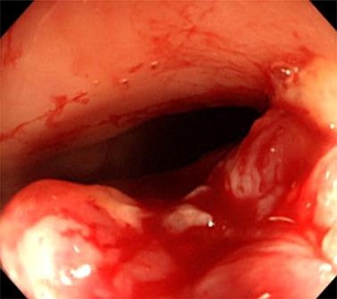 Colonoscopy findings. Colonoscopy showed a malignant tumor of the rectum. The tumor was localized, and invasion outside the colonic wall was suspected.