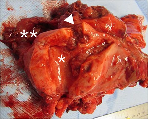 Macroscopic findings of the uterus. The uterus (*), intestine and rectum (**) formed a solid mass, and a colouterine fistula (arrowhead) was present.