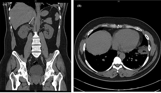 CT urogram showing (A) right peri-nephric fat stranding (white arrow) with left lower lobe consolidation (red arrow) and (B) transverse section highlighting the left basal consolidation.