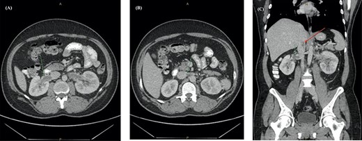 Abdominal CT with contrast showing (A) an enlarged right renal vein with a filling defect, (B) left renal vein distension and filling defect with (C) extension into the lower intra-hepatic inferior vena cava (red arrow).