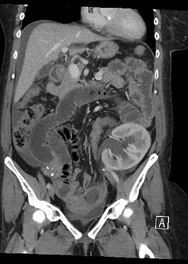 Initial CT demonstrating SBO and obstructed renal allograft/ureter (double obstruction).