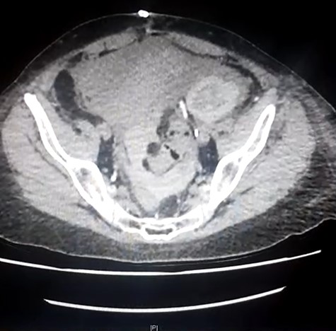 CT demonstrating heterogenous free fluid in pelvis.
