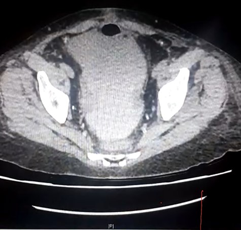 CT demonstrating heterogenous free fluid in pelvis.