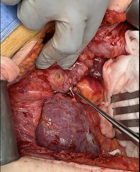 Intraoperative photo demonstrating divided transplant ureter with diathermy burn seen on bladder at previous site of anastomosis.
