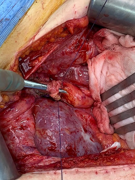 Forceps through bladder demonstrating route of ureter through Boari flap.