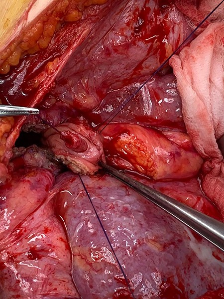 Ureter positioned in the Boari flap.