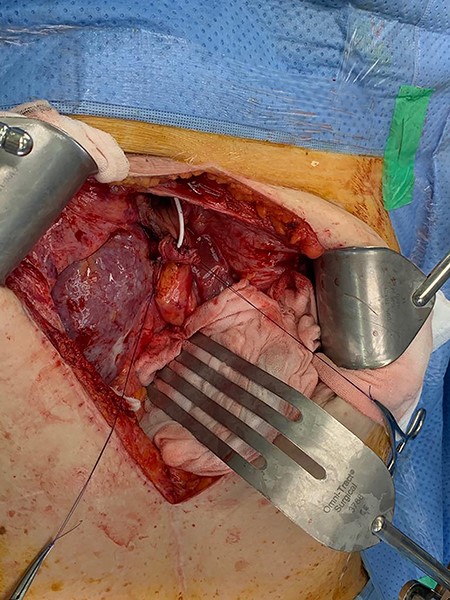 Stent placed through ureter prior to Boari flap closure.