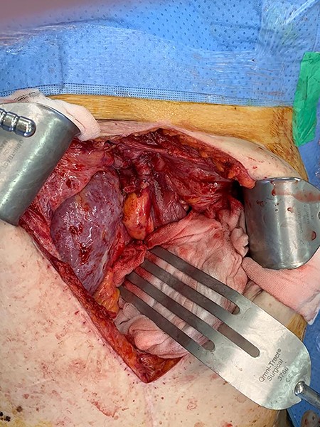 Ureter successfully reimplanted.