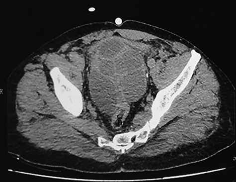 CT scan showing pelvic multilocular heterogeneous cystic mass with many septum mildly enhancing after contrast.