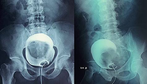 Presence of a 12-cm mass projecting on the bladder area in the cystography.