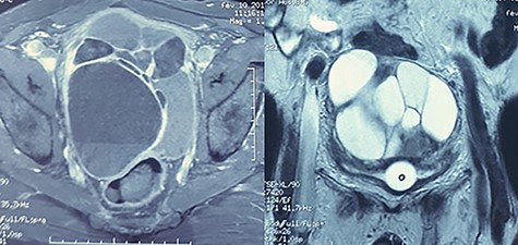 MRI: multilocular cystic formation of heterogeneous signal, with the presence of liquid level in some loci, having a T1 hypersignal and T2 hyposignal.