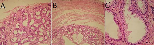 Pathological examination: (A and B) cystic wall containing numerous acini and dilated glandular structures (HES×10 and ×4); (C) Acini and cysts lined by prostatic-type epithelium (HES×20).