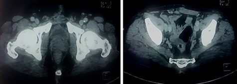 Control CT scan at 9 months postoperatively: the bladder and prostate are normal in appearance and there is no residual mass.