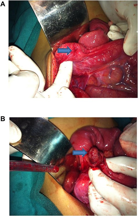 (a) Appendiculo-cecal intussusception. (b) Fibrosed appendix seen after enterotomy.