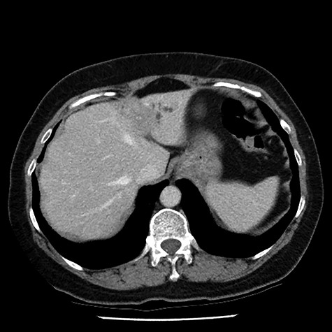 post-contrast multiphase helical computed tomography identified a 26 × 25 mm ill-defined region of hypodensity, with a small focus of central calcification, within segments II and III of the liver