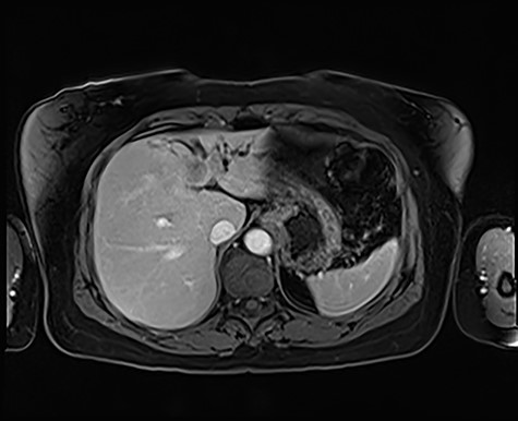 magnetic resonance imaging, T2-weighted image demonstrating an irregular, enhancing mass within segment IV that has a central area of non-enhancing low signal intensity