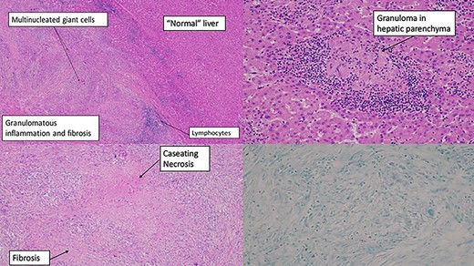 (A) resected liver specimen—routine formalin-fixed tissue stained with haematoxylin and eosin. Granulomas and fibrosis with demarcation with adjacent normalish liver parenchyma. (B) Resected liver specimen—routine formalin-fixed tissue stained with haematoxylin and eosin showing a necrotizing granuloma surrounded by lymphocytes within the liver parenchyma. (C) Biliary duct—routine formalin-fixed tissue stained with haematoxylin and eosin. Granulomas centred around an intrahepatic bile duct, replacing some of the epithelium. (D) Bottom right—Ziehl–Neelsen stain (negative for acid-fast bacilli)