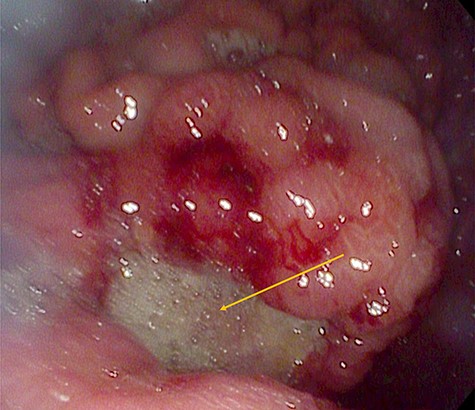 A giant gastric ulcer in the antrum during gastroscopy (orange arrow).