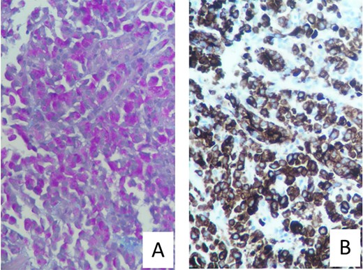 (A) Mucicarmine stain with diffuse sheets of malignant cells and rare glandular formation. The mucin is intracytoplasmic. (B) Pankeratin immunohistochemistry with positive Pankeratin confirms the epithelial linage of the malignant infiltration.