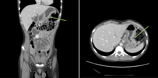 : (A and B) CT scans (coronal and axial views) showing a large mass in the distal stomach (green arrows).
