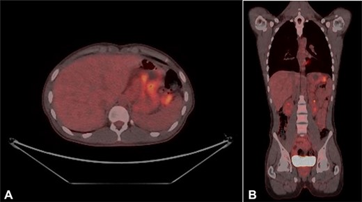 (A and B) PET scans (axial and coronal views) showing enlarged D1 perigastric lymph nodes (green arrows) and no apparent metastatic disease.