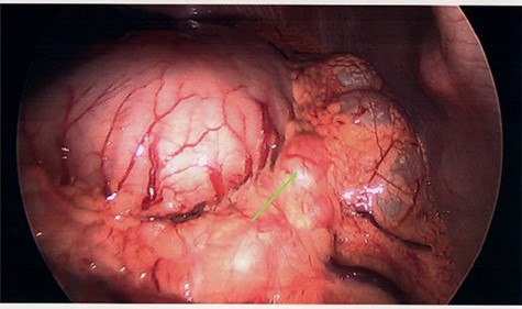 Clinically irresectable gastric tumour with large, visible perigastric lymph nodes, visualized on diagnostic laparoscopy (green arrow).