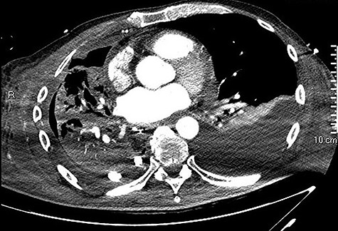 Initial CT showing a right hydropneumothorax after chest tube placement.