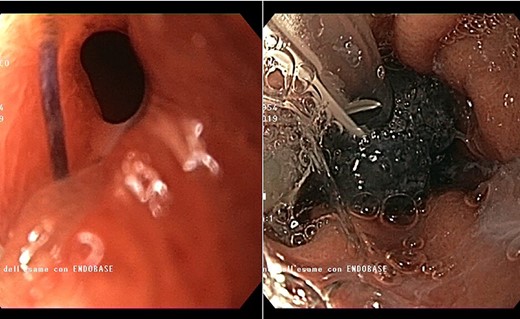 Endoscopic view of the prepyloric ulcer perforation (left) and intraluminal placement of E-VAC (right)