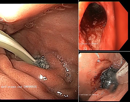 Intracavitary placement of E-VAC with prompt progressive improvement of the cavity size.