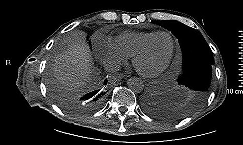 CT scan of intracavitary placement of E-VAC.
